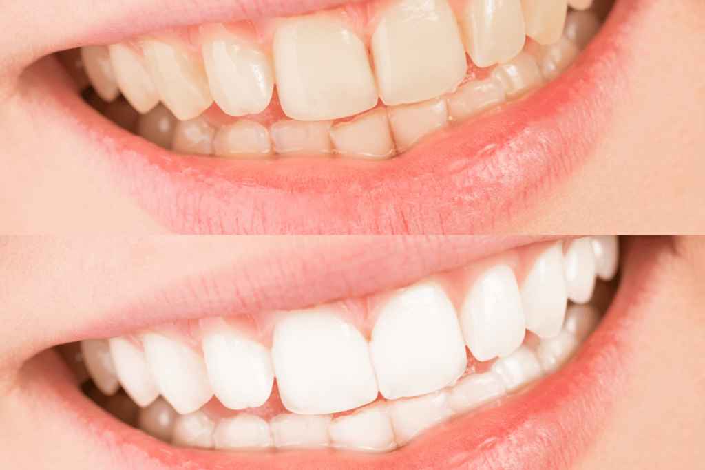 Sonrisa Radiante sin Químicos: 7 Recetas Naturales para Blanquear tus Dientes